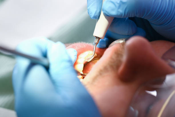 Best Emergency Wisdom Tooth Extraction in Northwest Harwinton, CT